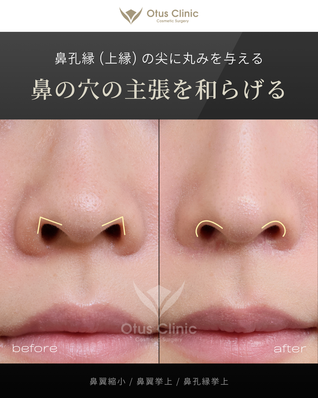鼻翼縮小・鼻翼挙上・鼻孔縁挙上