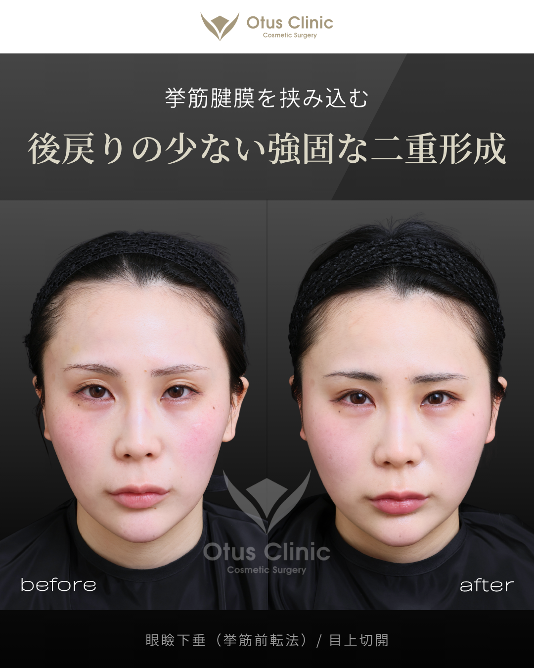 眼瞼下垂（挙筋前転法）・目上切開