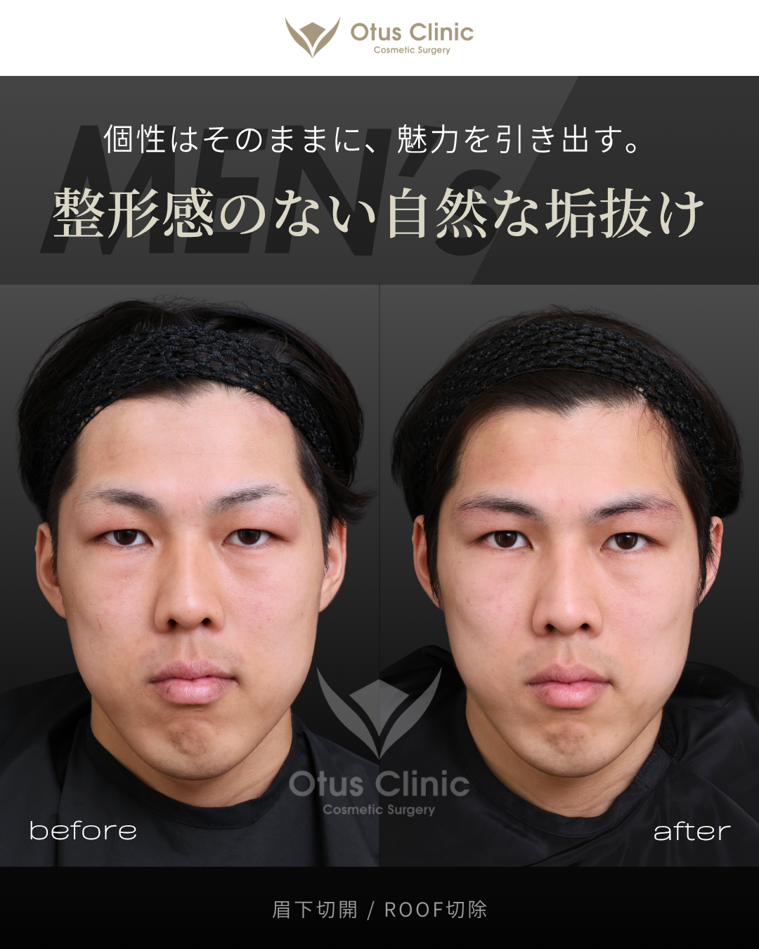 眉下切開・ROOF切除