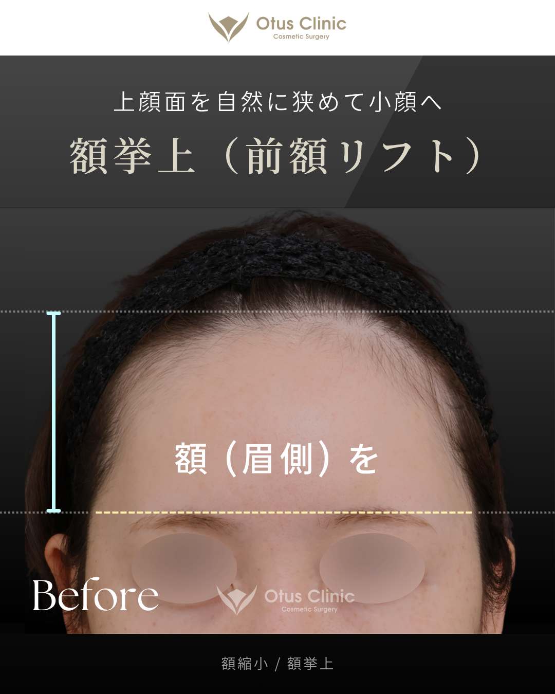 額縮小・額挙上（前額リフト）