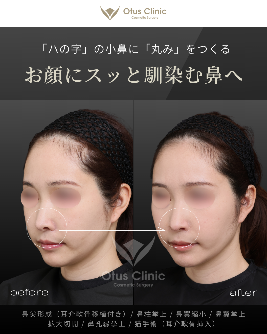 鼻尖形成（耳介軟骨移植付き）・鼻柱挙上・鼻翼縮小・鼻翼挙上・拡大切開・鼻孔縁挙上・猫手術（耳介軟骨挿入）