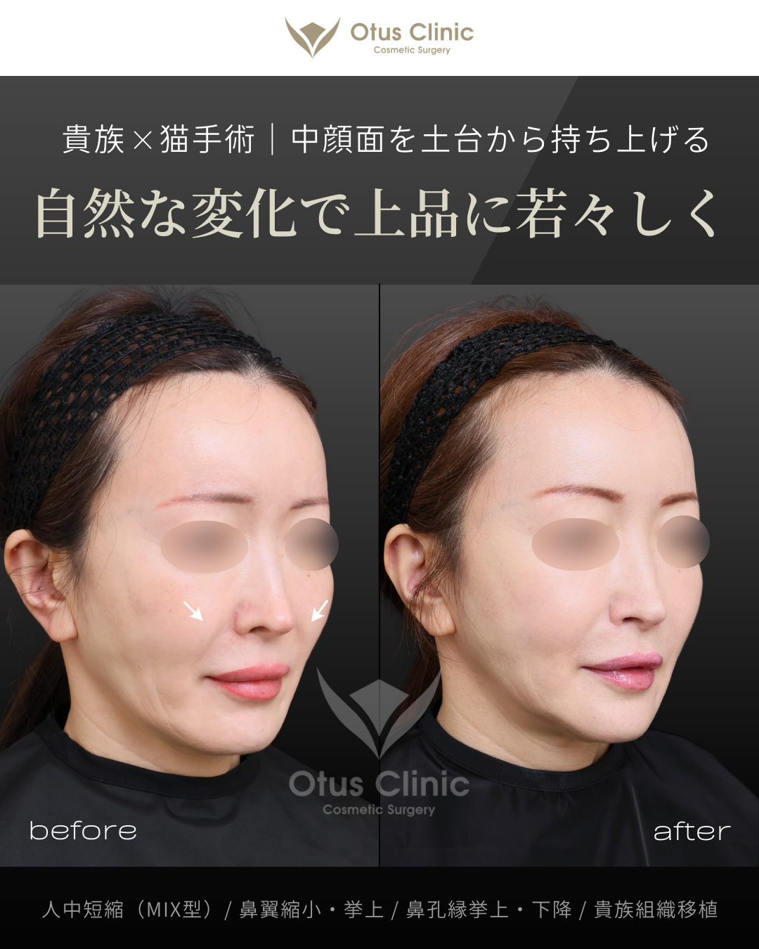 人中短縮（鼻柱切開×鼻腔内切開）・鼻翼縮小・鼻翼挙上・鼻孔縁挙上・鼻孔縁下降・貴族組織移植