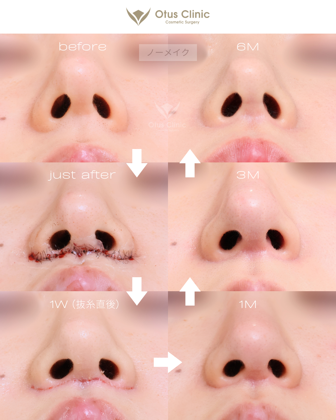 人中短縮（鼻下切開）