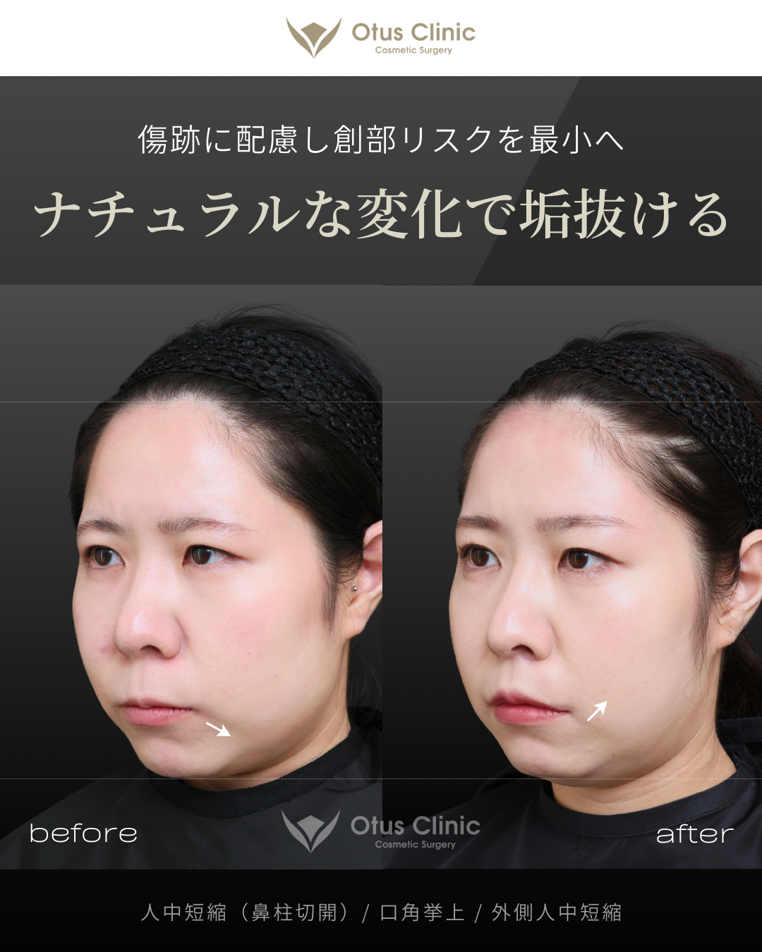 鼻柱切開人中短縮・口角挙上・外側人中短縮