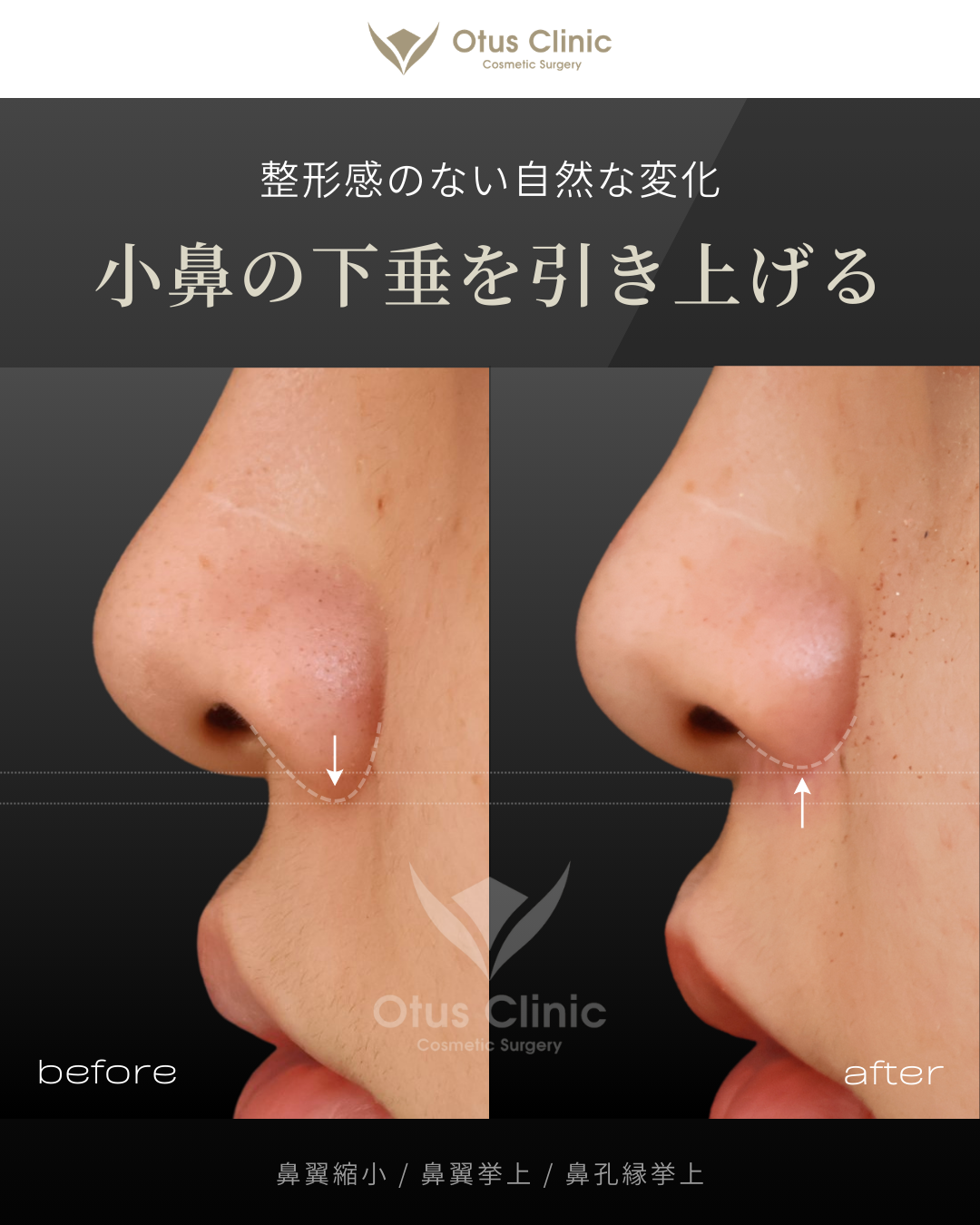 鼻翼縮小・鼻翼挙上・鼻孔縁挙上