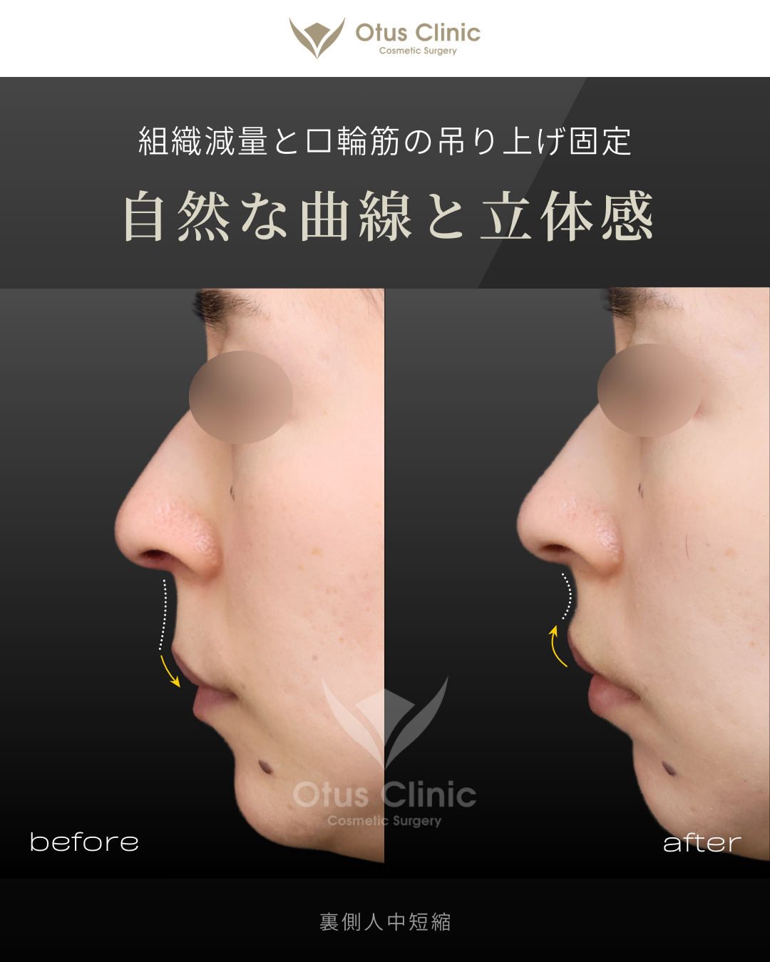 裏側人中短縮（切らない人中短縮）