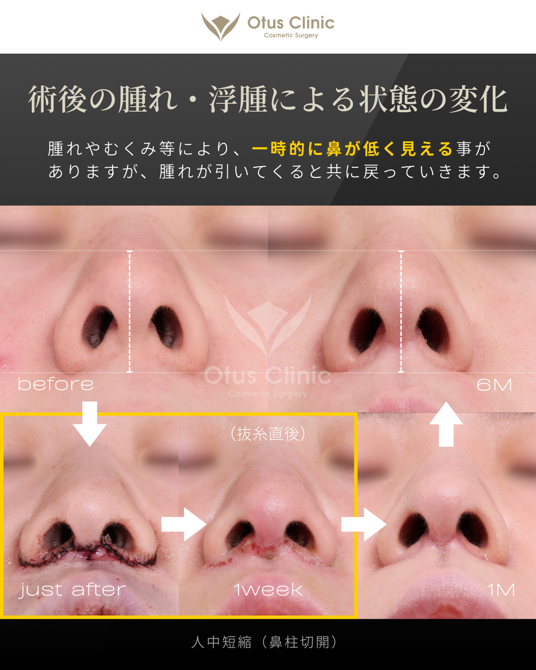 鼻柱切開人中短縮・口角挙上・外側人中短縮