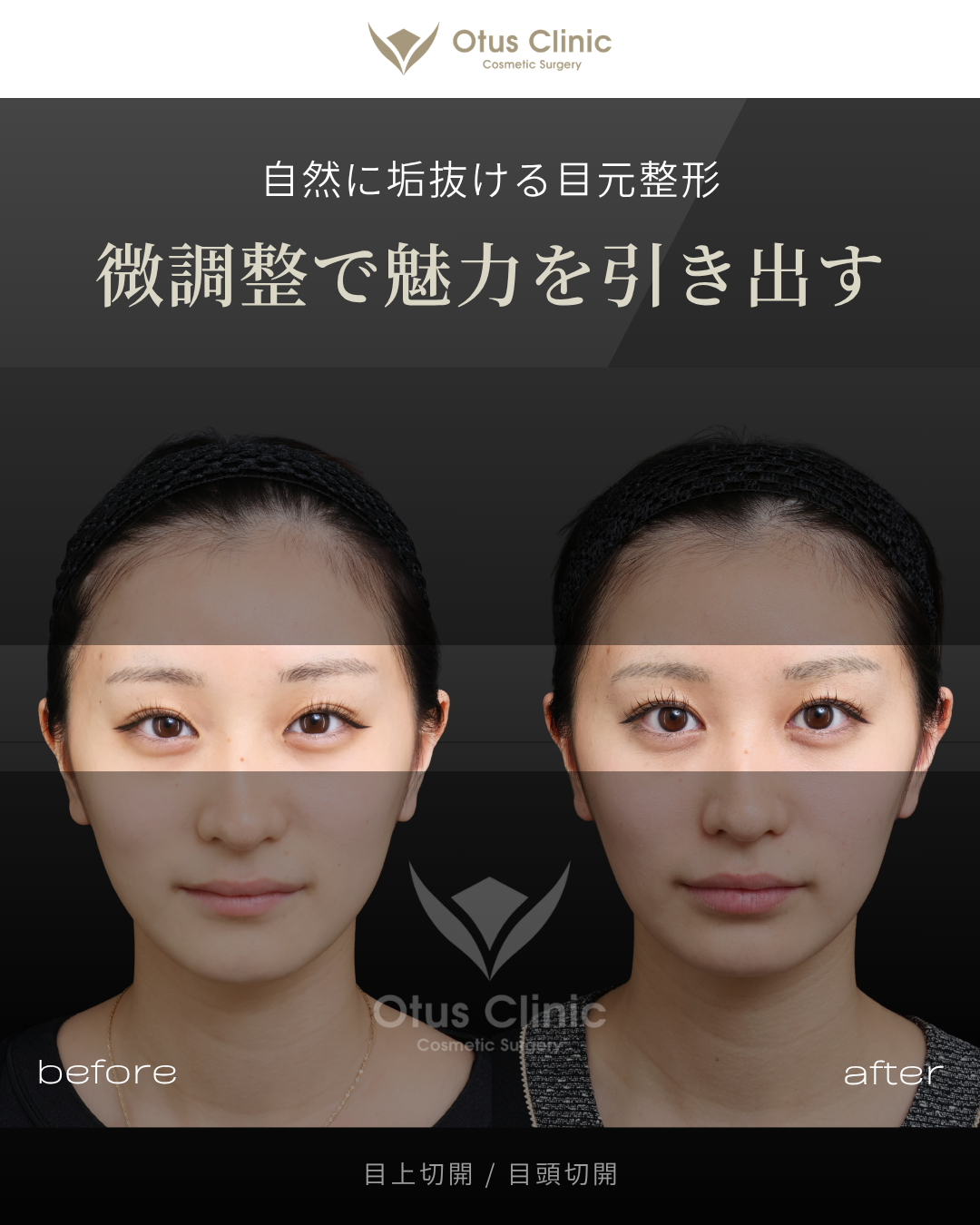 目上切開・目頭切開