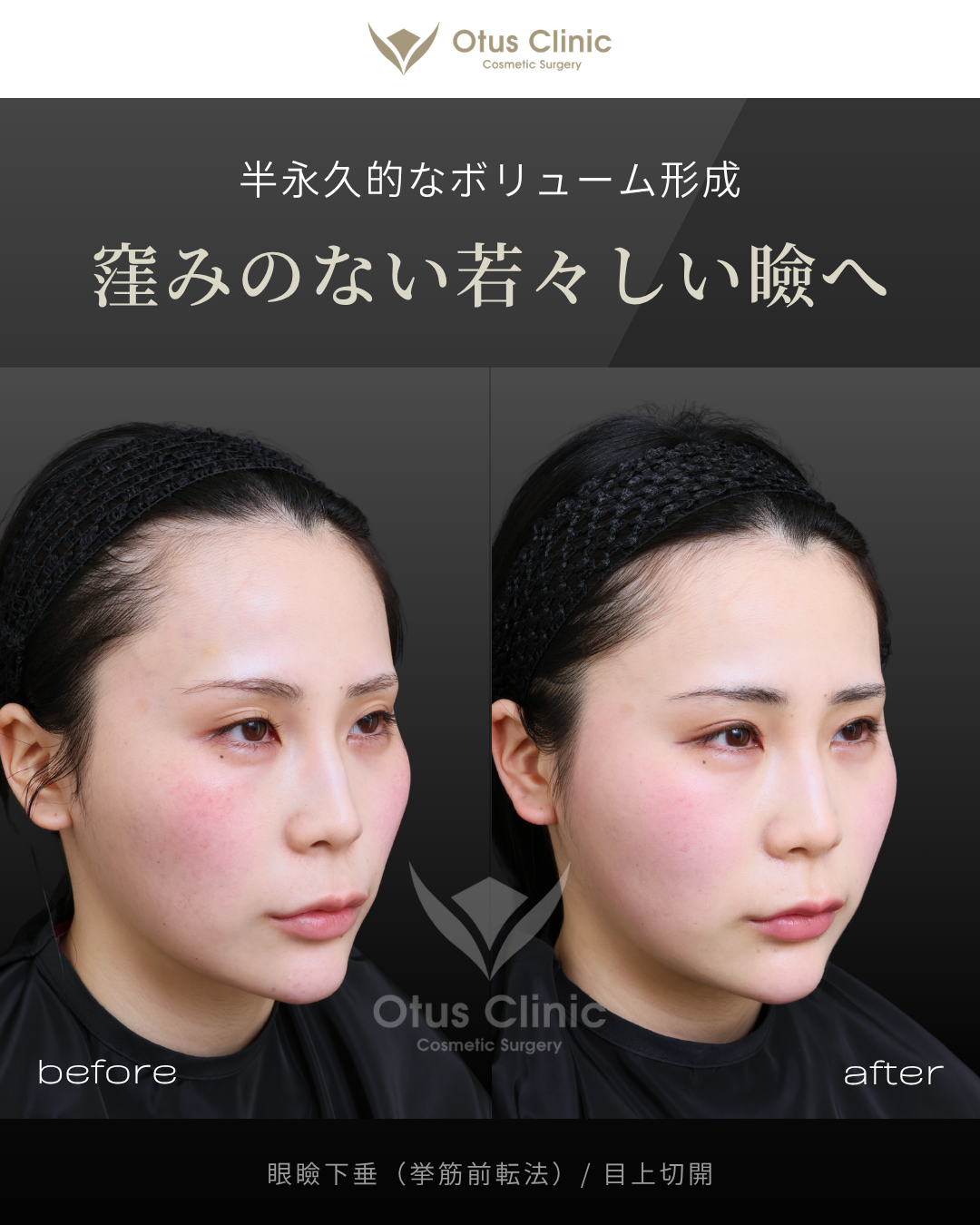 眼瞼下垂（挙筋前転法）・目上切開