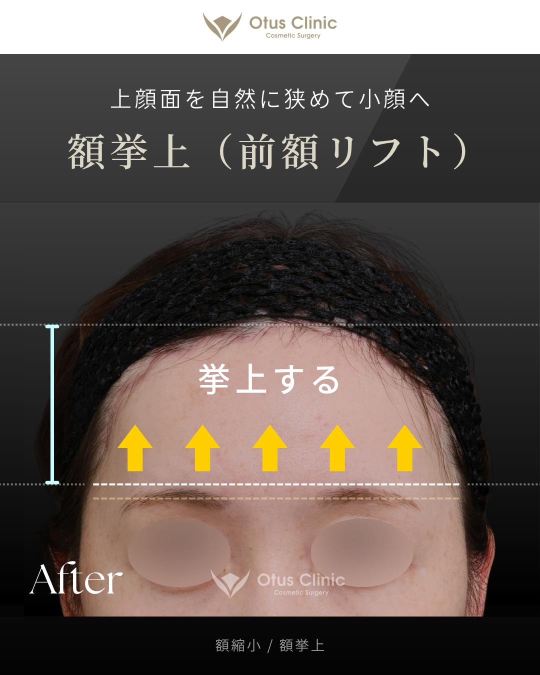 額縮小・額挙上（前額リフト）