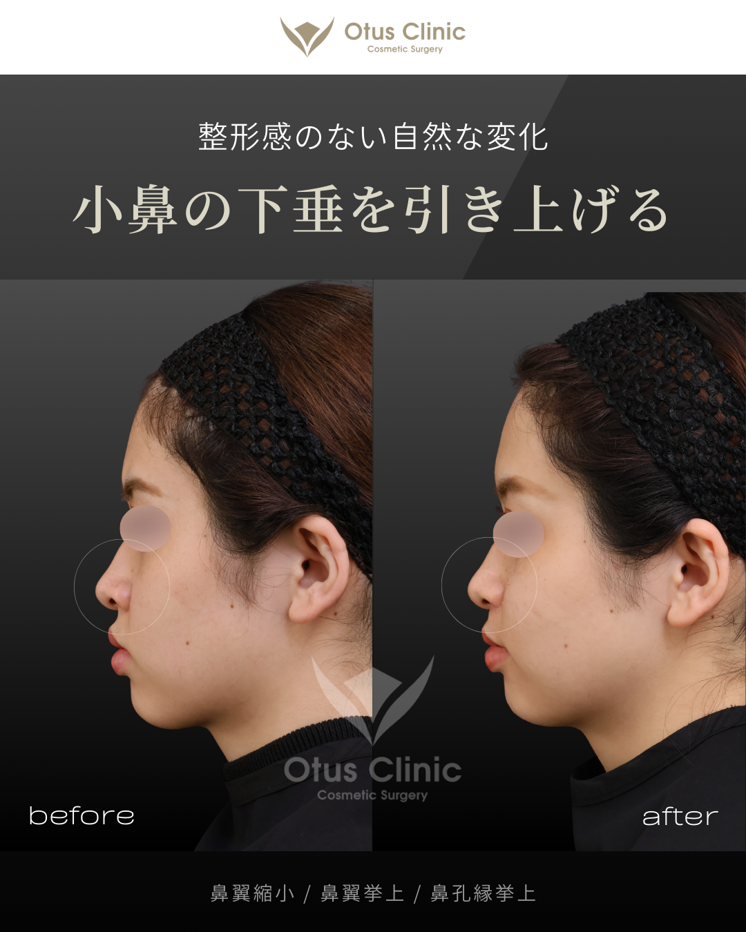 鼻翼縮小・鼻翼挙上・鼻孔縁挙上