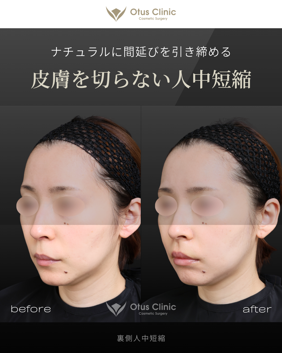 裏側人中短縮（切らない人中短縮）