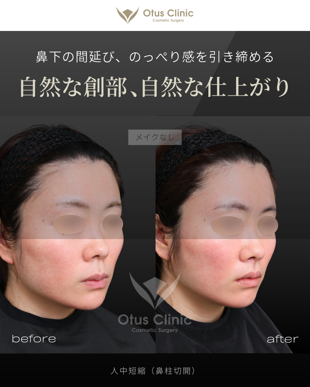 鼻柱切開人中短縮