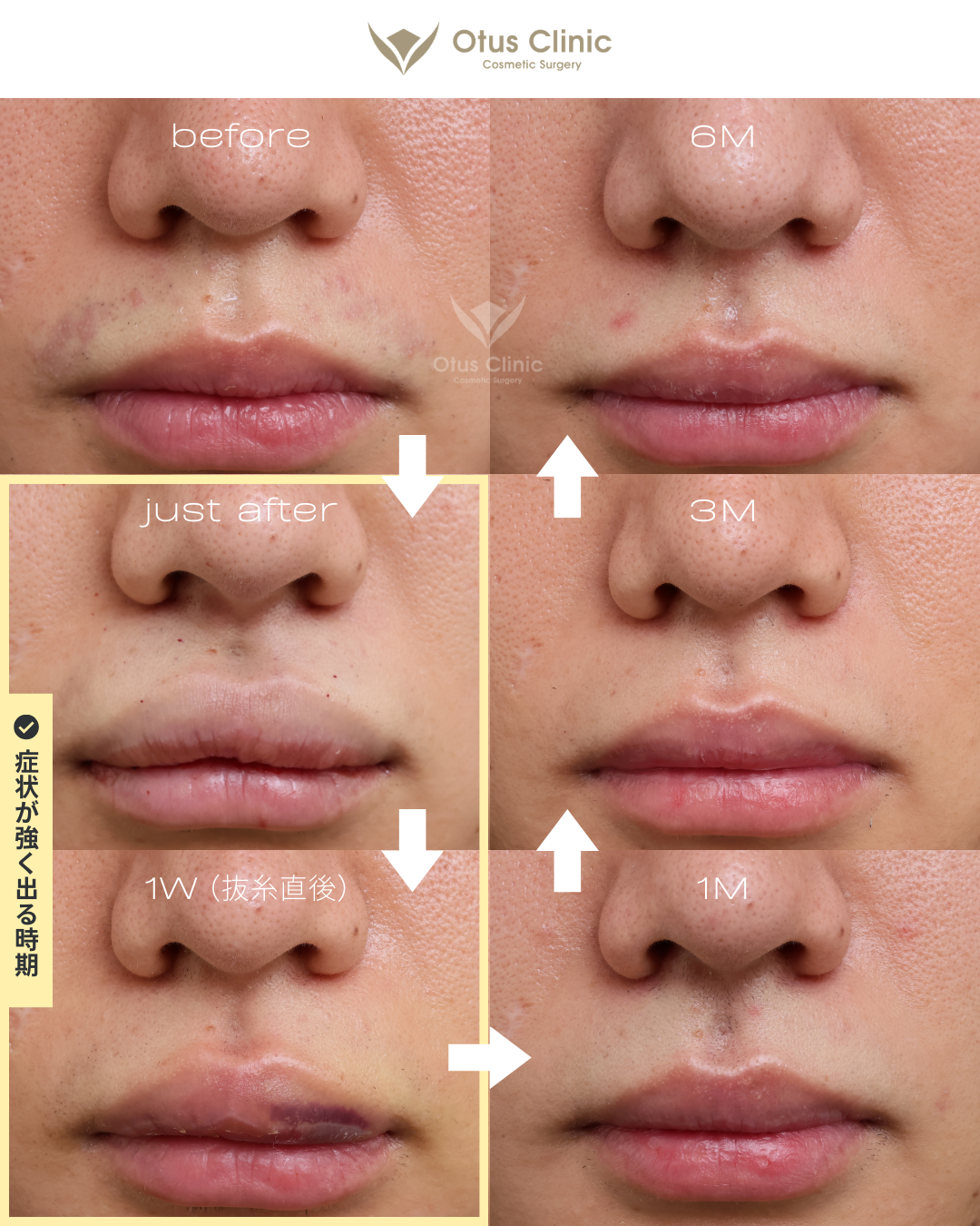 裏側人中短縮（切らない人中短縮）