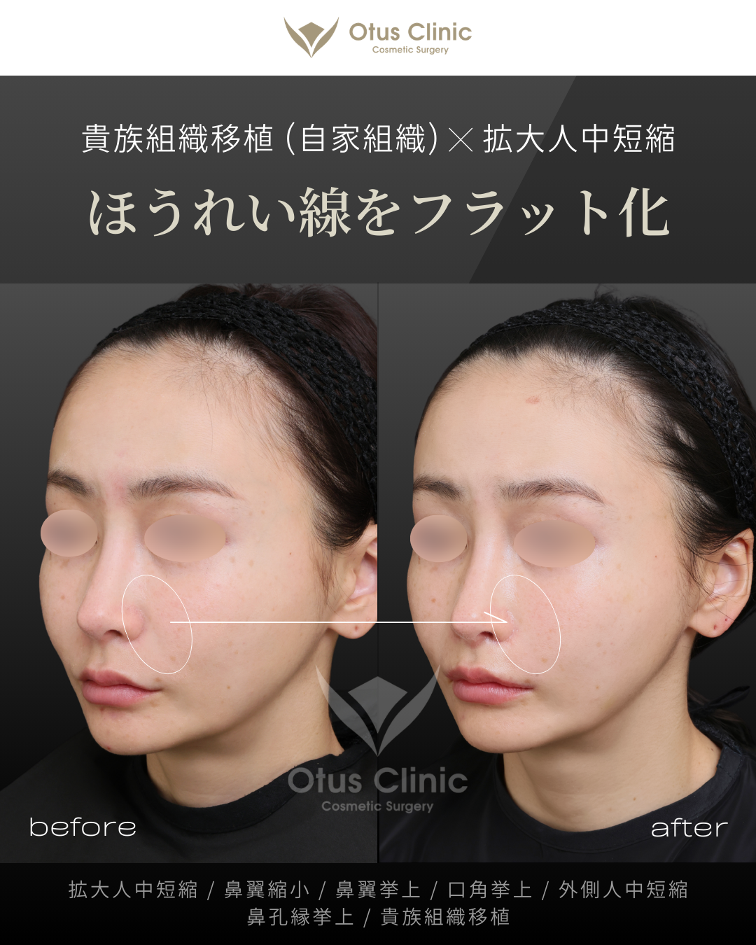 人中フル（人中短縮＋鼻翼縮小＋鼻翼挙上＋口角挙上＋外側人中短縮）・拡大人中短縮・貴族組織移植・鼻孔縁挙上