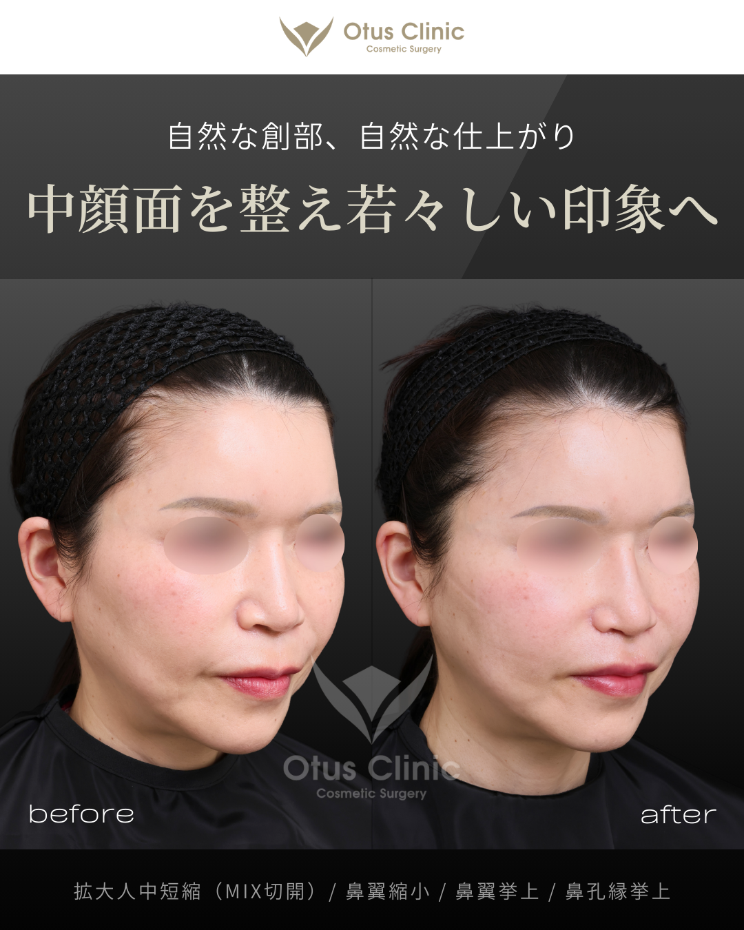拡大人中短縮（MIX切開）/ 鼻翼縮小 / 鼻翼挙上 / 鼻孔縁挙上