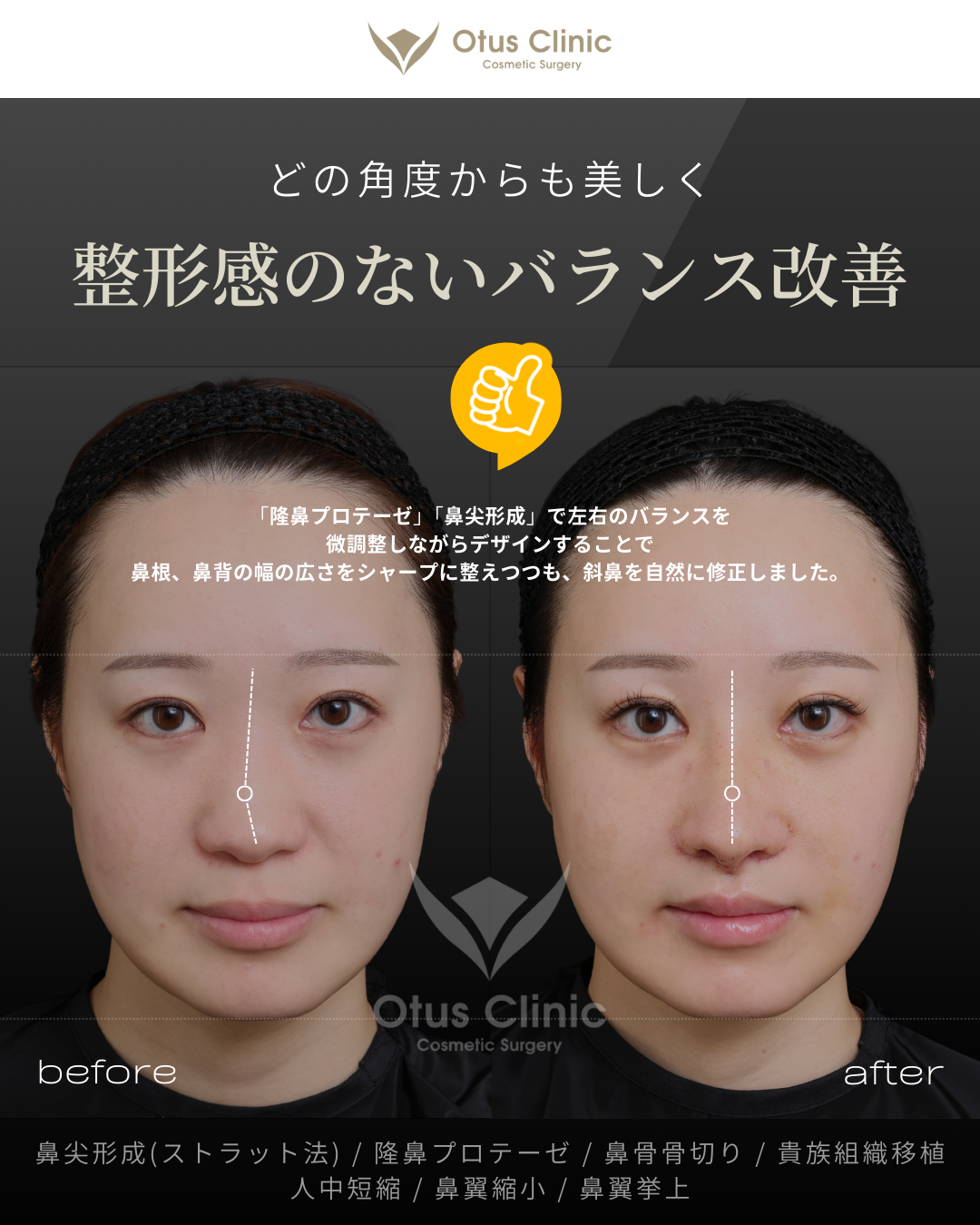 鼻尖形成(耳介軟骨移植つき)・ストラット法・隆鼻プロテーゼ・鼻骨骨切り・貴族組織移植・鼻柱切開人中短縮・鼻翼縮小・鼻翼挙上