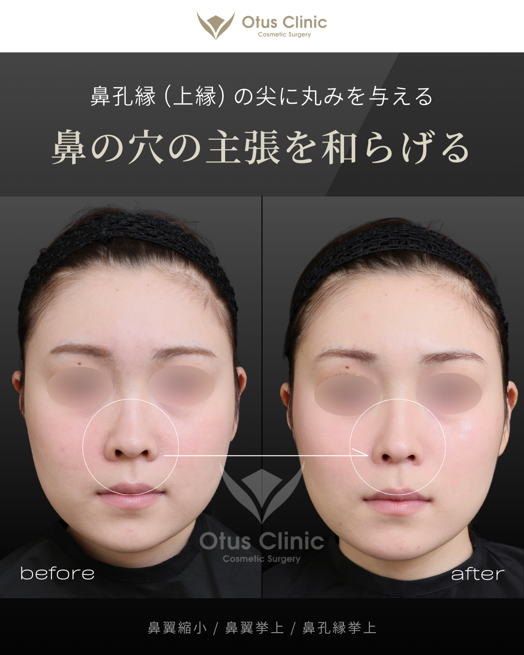 鼻翼縮小・鼻翼挙上・鼻孔縁挙上