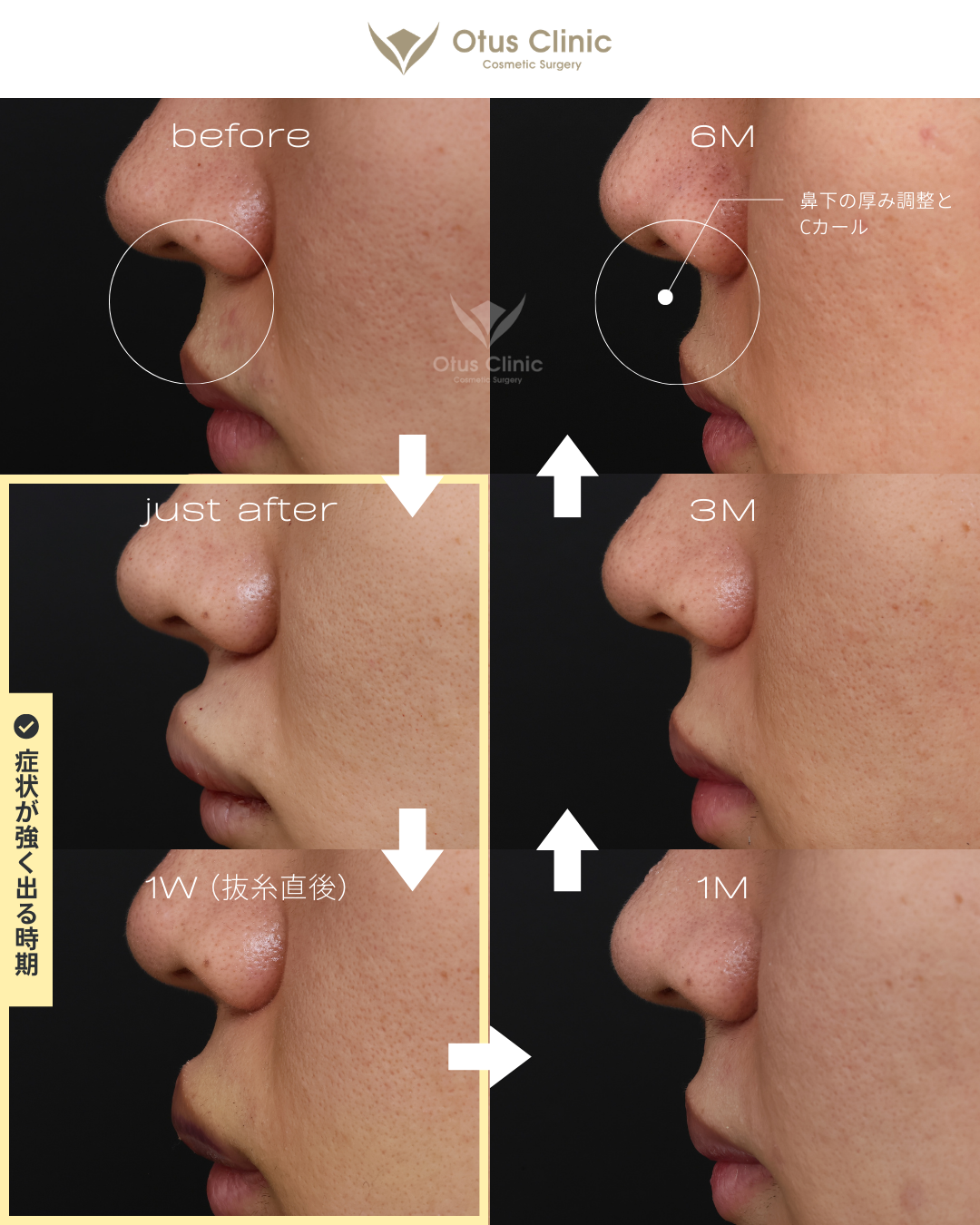 裏側人中短縮（切らない人中短縮）