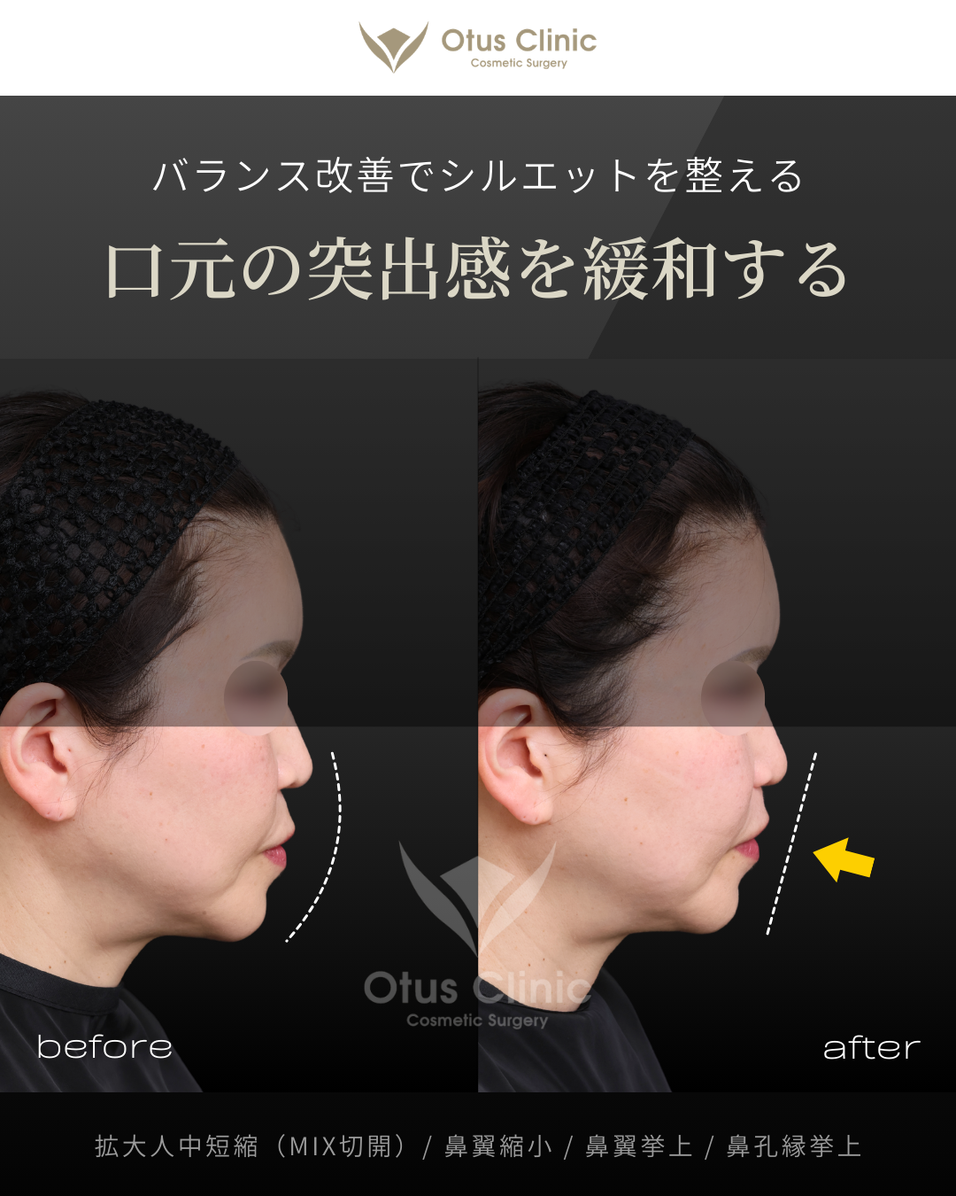 拡大人中短縮（MIX切開）/ 鼻翼縮小 / 鼻翼挙上 / 鼻孔縁挙上