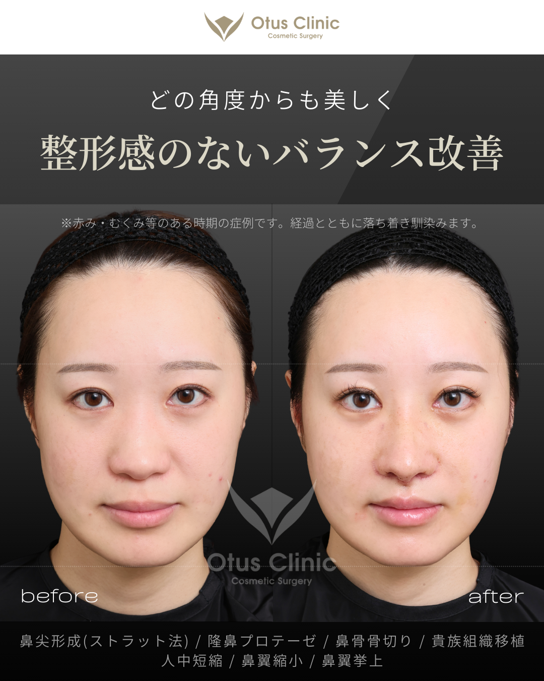 鼻尖形成(耳介軟骨移植つき)・ストラット法・隆鼻プロテーゼ・鼻骨骨切り・貴族組織移植・鼻柱切開人中短縮・鼻翼縮小・鼻翼挙上