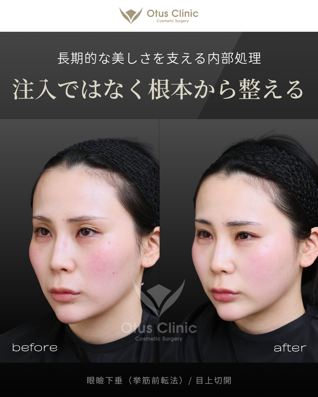 眼瞼下垂（挙筋前転法）・目上切開