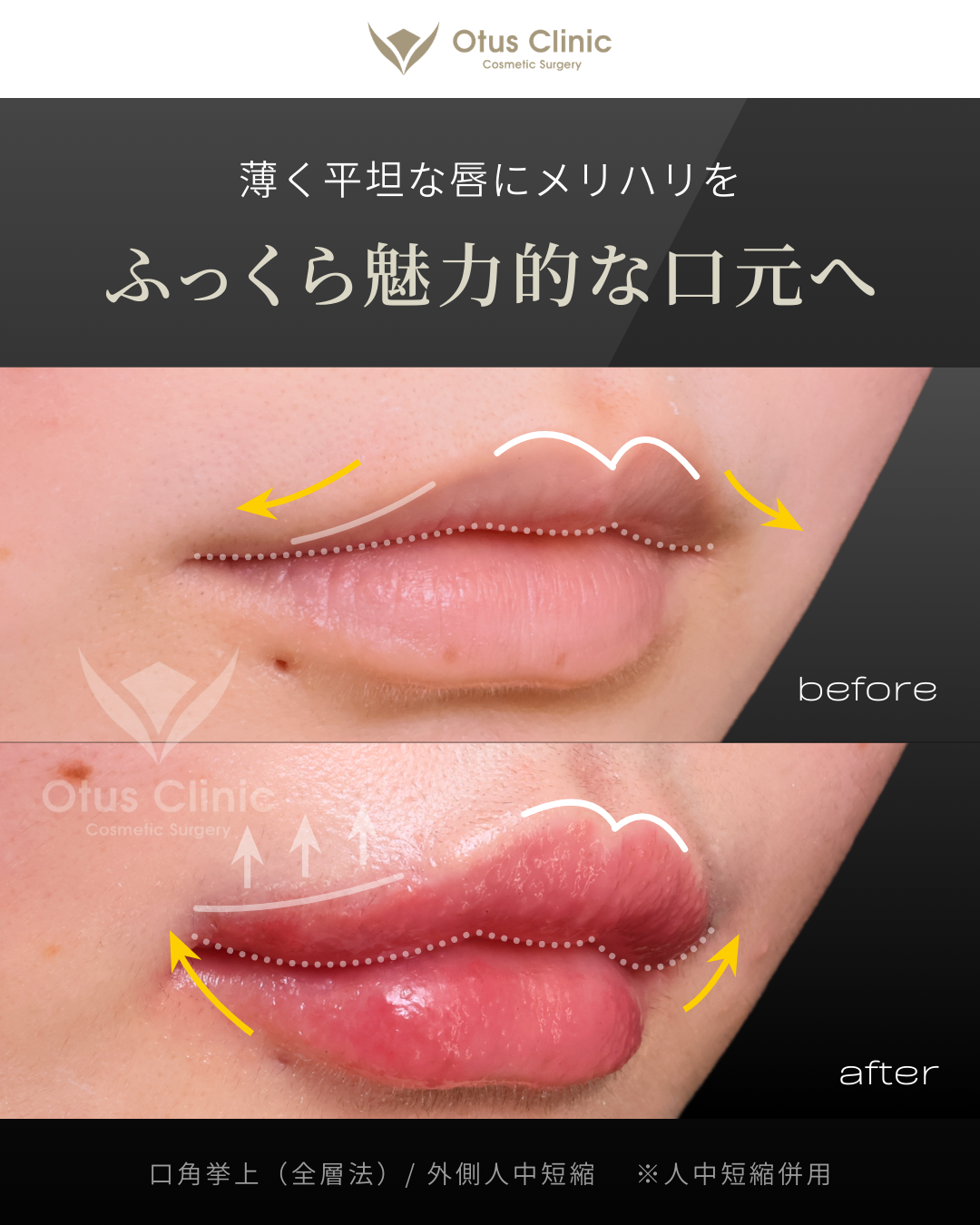 口角挙上・外側人中短縮・人中短縮