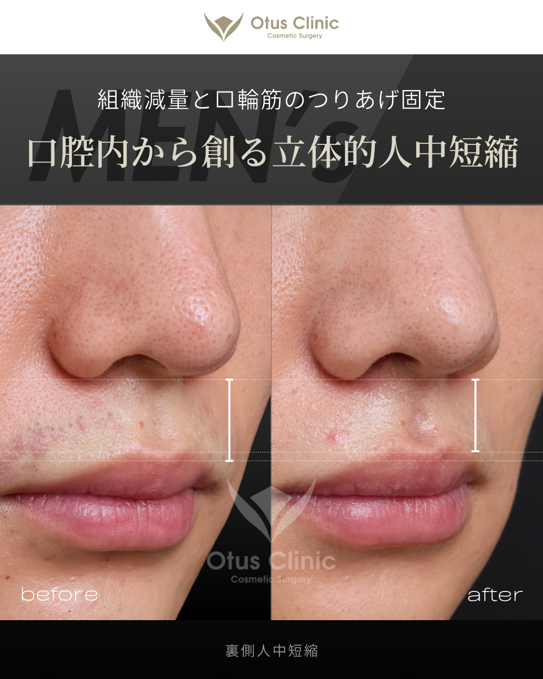 裏側人中短縮（切らない人中短縮）