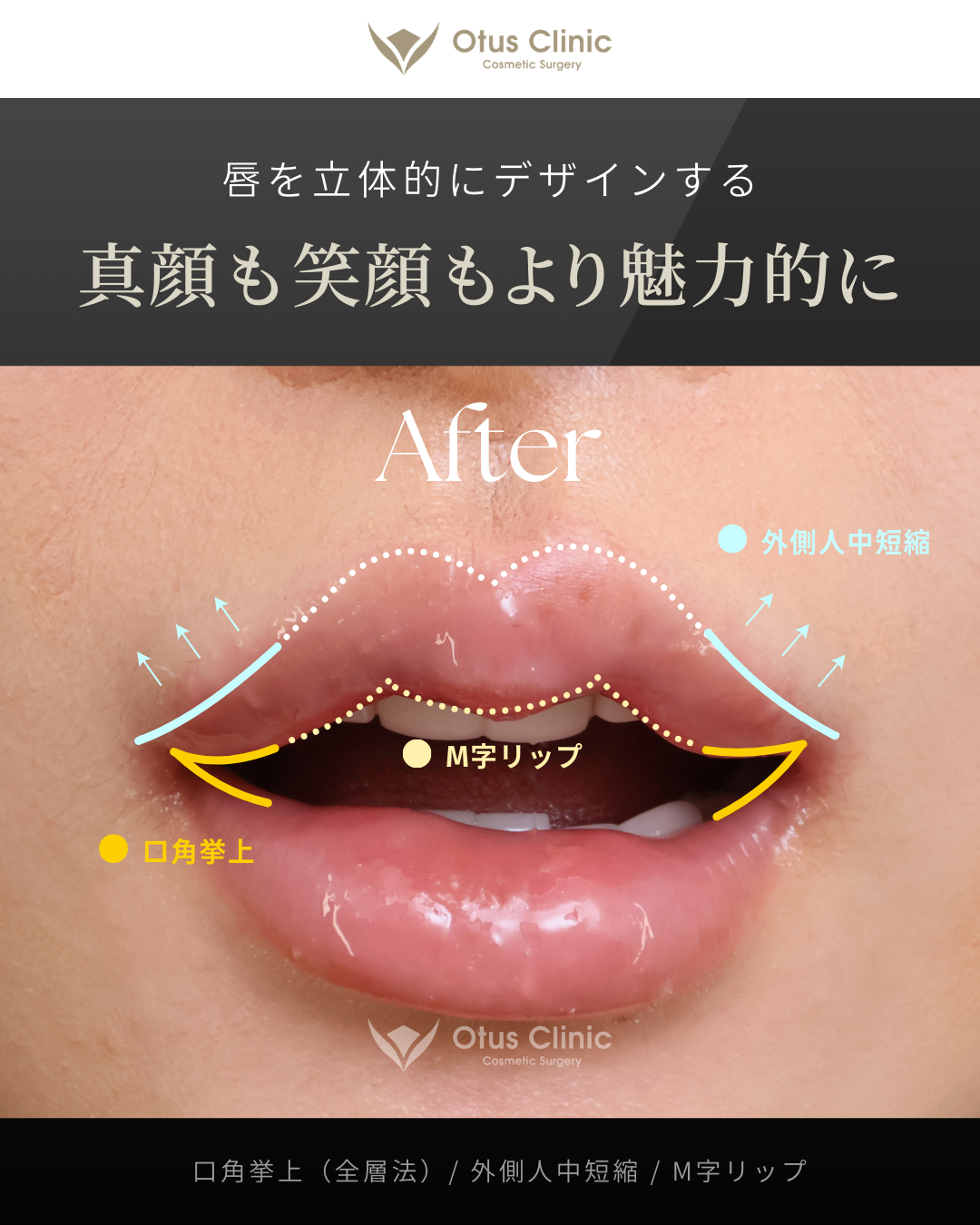 口角挙上（全層法）・外側人中短縮・M字リップ