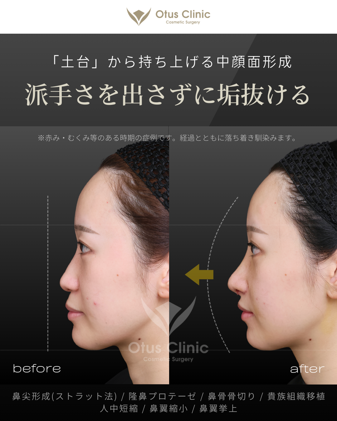 鼻尖形成(耳介軟骨移植つき)・ストラット法・隆鼻プロテーゼ・鼻骨骨切り・貴族組織移植・鼻柱切開人中短縮・鼻翼縮小・鼻翼挙上