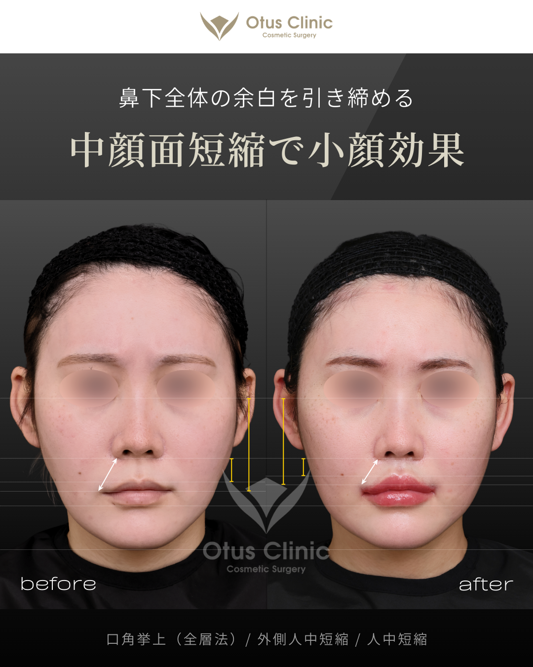 口角挙上・外側人中短縮・人中短縮
